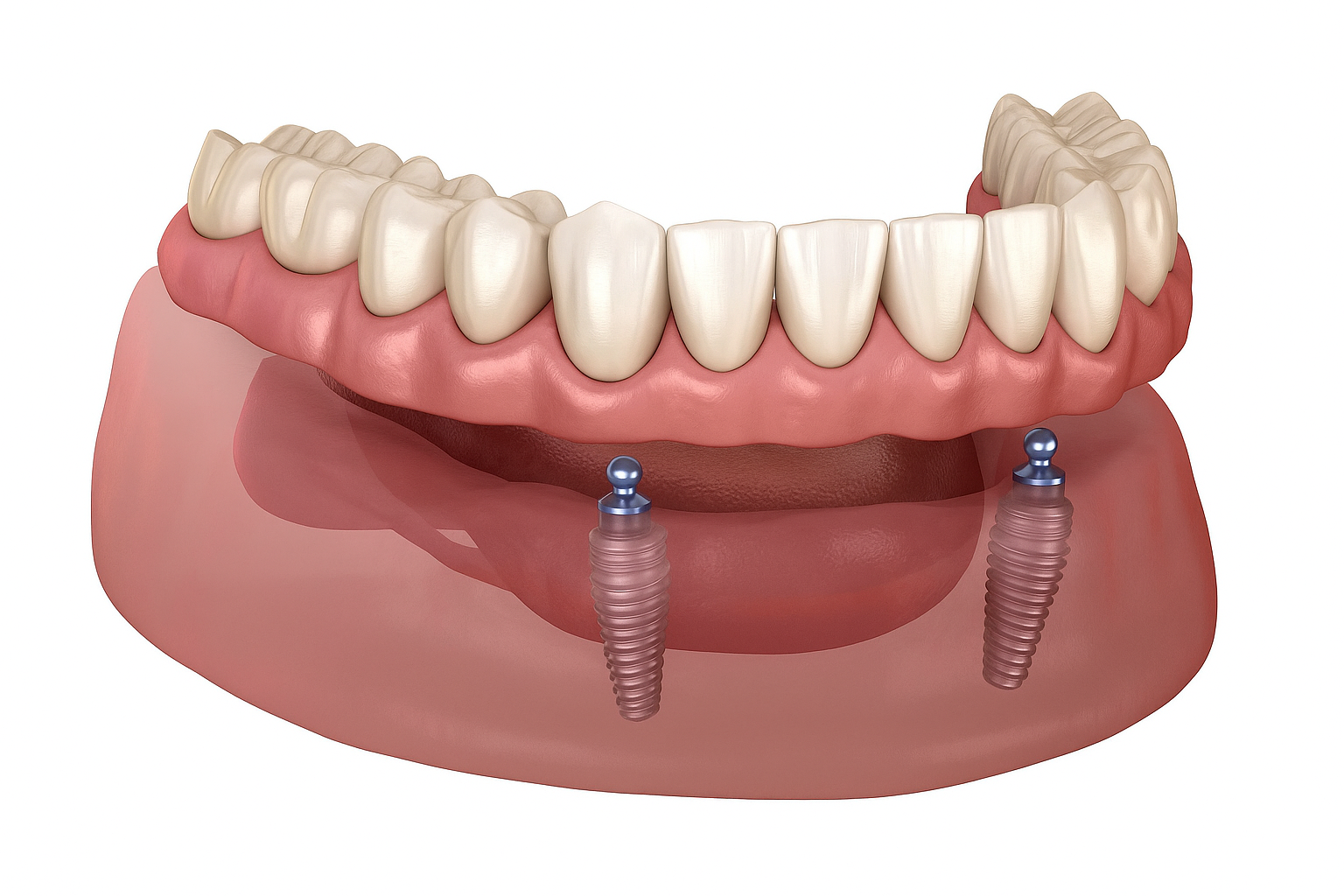 A smiling person with implant-retained dentures